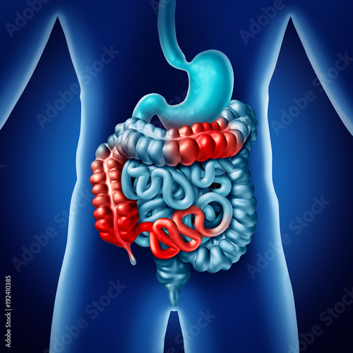 Obraz na plátně Crohn illness