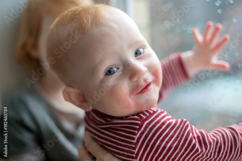 Baby with manifestations of food allergy on the face