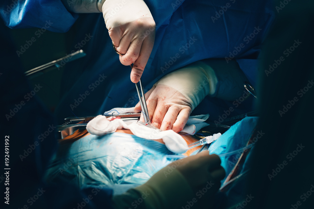 Team of surgeons hands holding needle holder or a needle driver, a