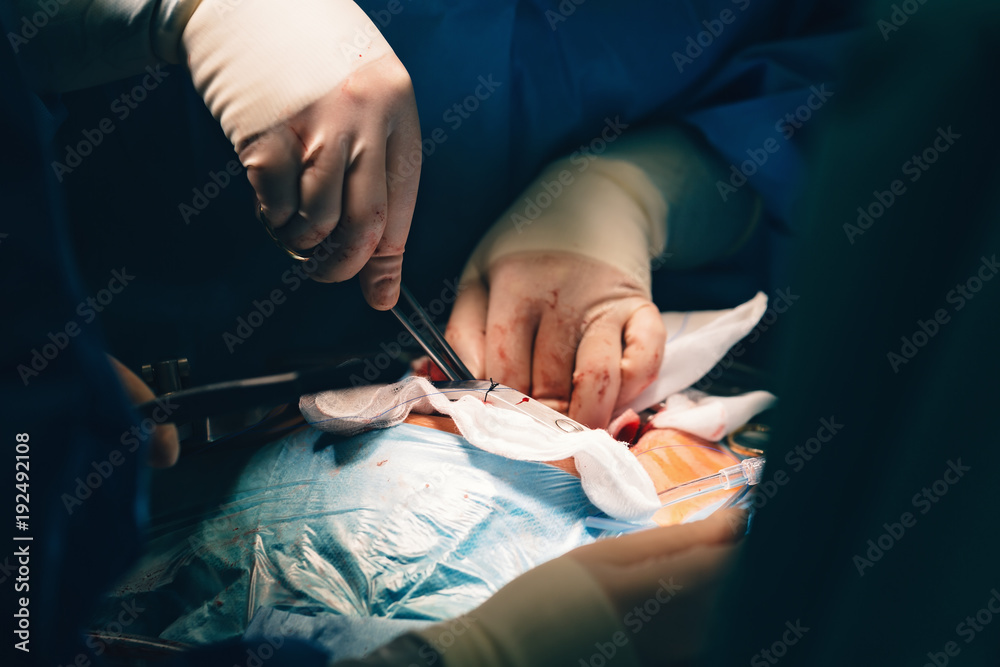 Needle holder or a needle driver in doctor's hand, a surgical