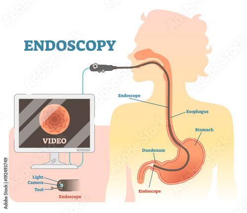 Endoscopy anatomical vector illustration diagram, medical scheme.
