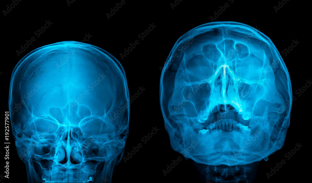 Xray image of skull and paranasal sinuses (PNS).Everything is fine foto de Stock Adobe Stock