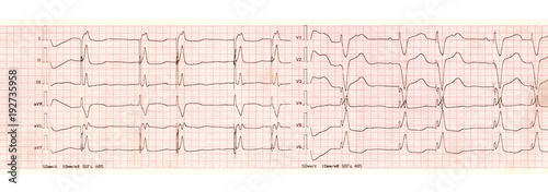 ECG with pacemaker arrhythmia (ventricular stimulation)