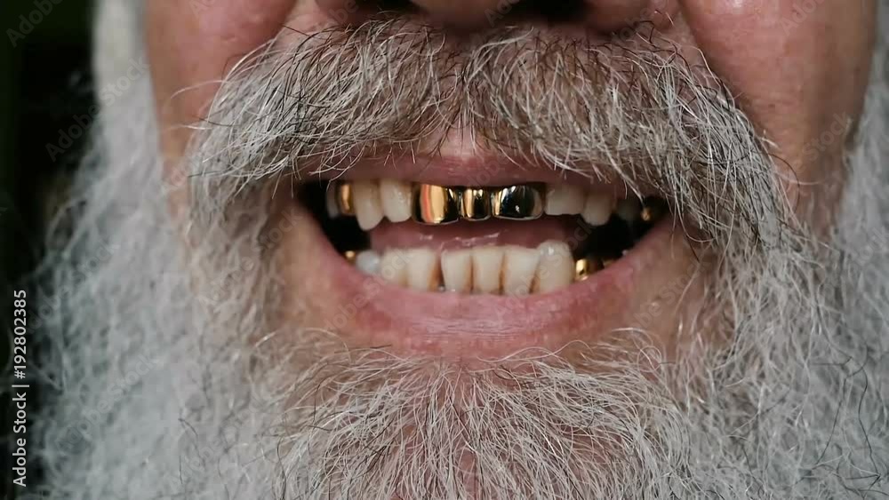 man with false front upper teeth. metal false teeth