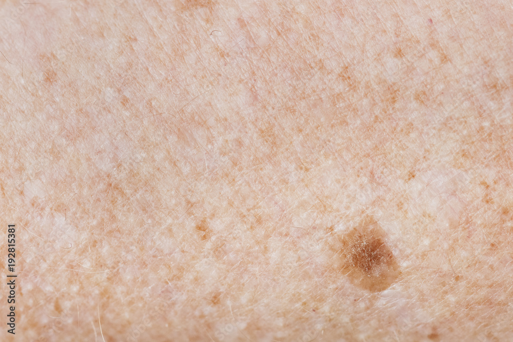 Closeup of freckled skin Closeup of freckled skin