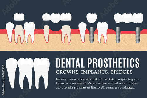 Dental prosthetics illustration