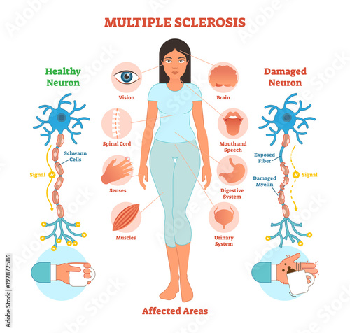 Multiple sclerosis anatomical vector illustration diagram, medical scheme.