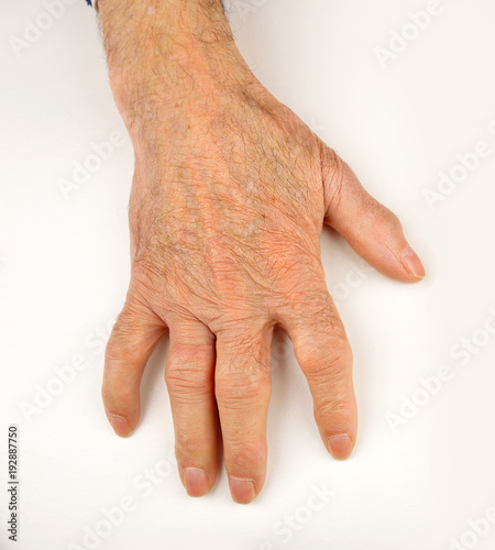 Hand Deformed From Rheumatoid Arthritis