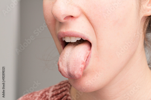 Tongue of girl showing oral thrush photo