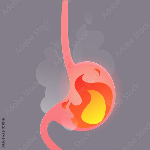 Illustration from acid reflux or heartburn, Cartoon vector, Concept with internal health