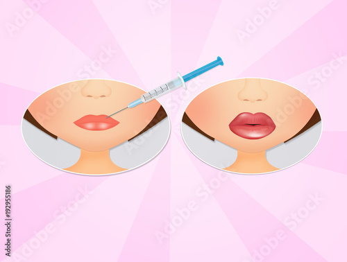 Obraz na płótnie before and after lip augmentation