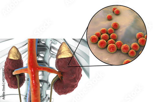 Pyelonephritis, medical concept, and close-up view of bacteria Enterococcus, the common causative agent of kidney infection, 3D illustration photo