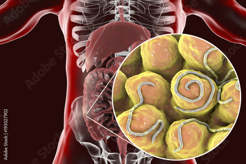 Helminths nematodes Enterobius in the gut. Threadworm which causes enterobiasis, 3D illustration showing close-up view of threadworms located in large intestine photo