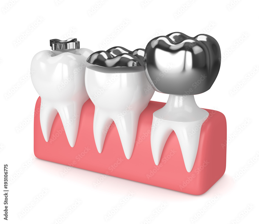 3d render of teeth with different types of dental amalgam filling Stock
