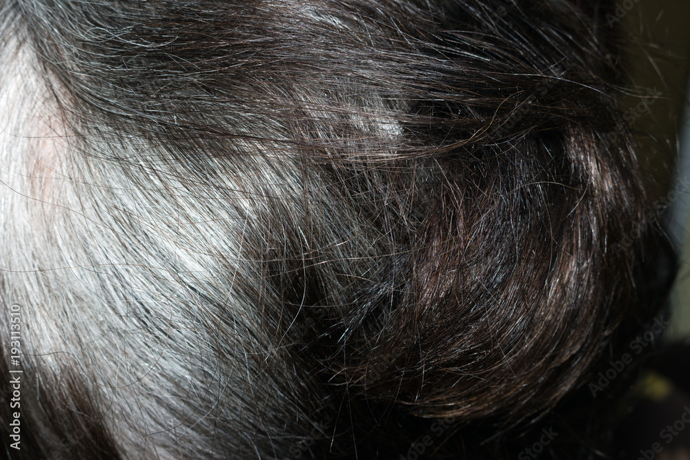 dandruff on the gray hair of an elderly person dandruff on the gray hair of an elderly person