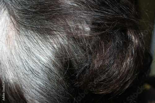 dandruff on the gray hair of an elderly person
