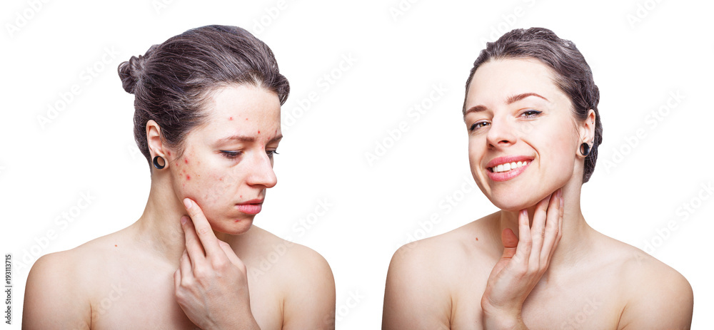 Young woman with cool dark grey hair looking upset about face skin problems and joyful after treatment. Before and after comparison. Isolated on white background. Young woman with cool dark grey hair looking upset about face skin problems and joyful after treatment. Before and after comparison. Isolated on white background.