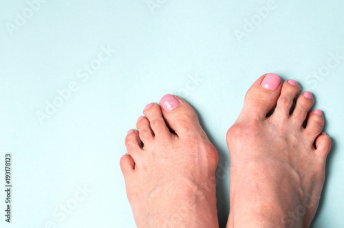 Valgus deformity. Flatfoot. Orthopedic problem and disease photo