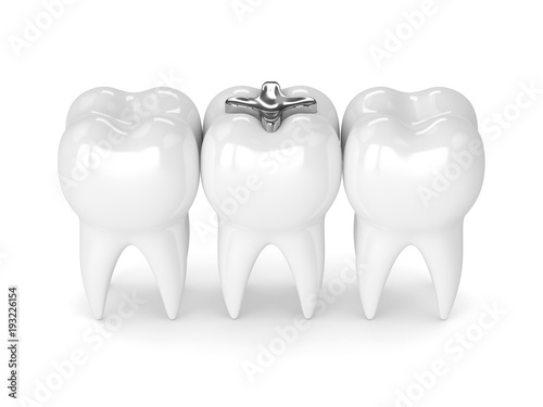 3d render of teeth with dental amalgam filling
