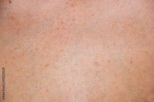 pigment spots on the skin of women