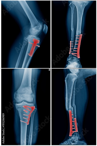 collection of leg with post operation internal fixation tibia and fibular bone photo