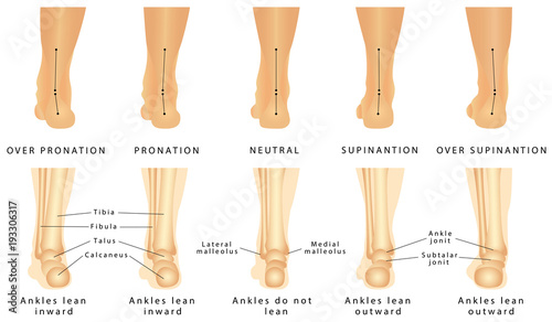 Foot deformation