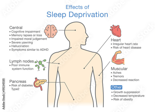 Diagram of Effects of Sleep deprivation. Illustration about disease diagnosis. 