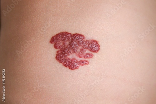 Infantile Hemangioma red birthmark (also called strawberry mark) on the baby's belly. Infantile Hemangiomas (IHs) are the most common tumors of childhood. photo