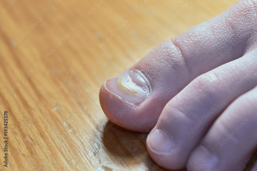 Effects of enterovirus on the body in the form of damage to the thumb