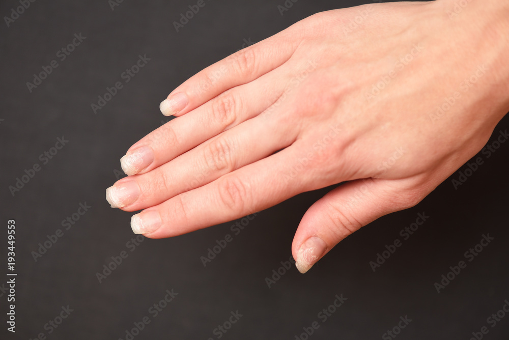 Torn off and broken nails, detachment of gel nails and delamination of natural nails. After gel nails