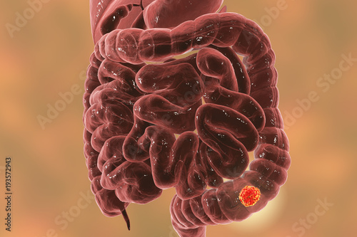 Fotografie Colorectal cancer awareness medical concept, 3D illustration showing cancerous t