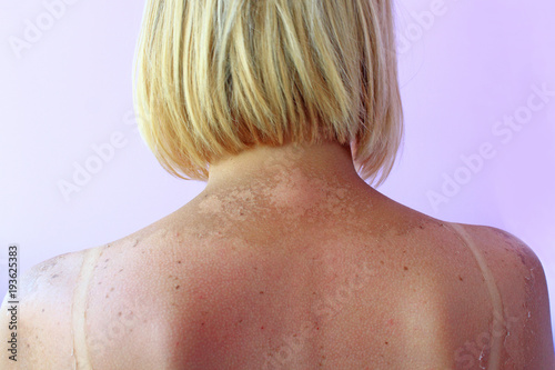 Sunburn from beach sun light on shoulder and back of caucacian girl. Body care