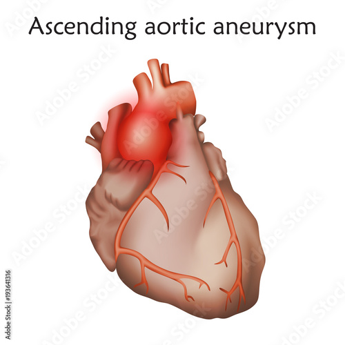 Ascending aortic aneurysm. Damaged heart muscle. Anatomy illustration. Colorful image, white background.