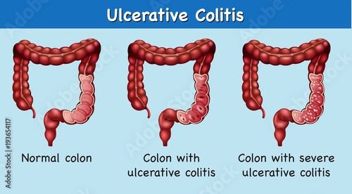 Diagram showing ulcerative colitis