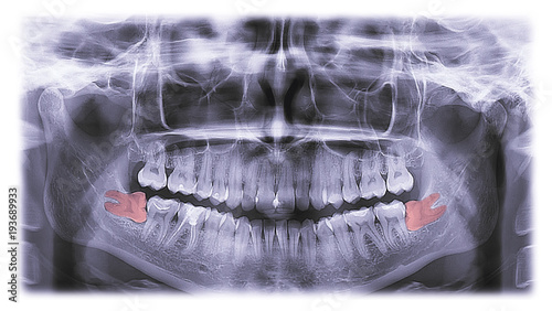 x-ray of teeth, molar tooth improperly growing