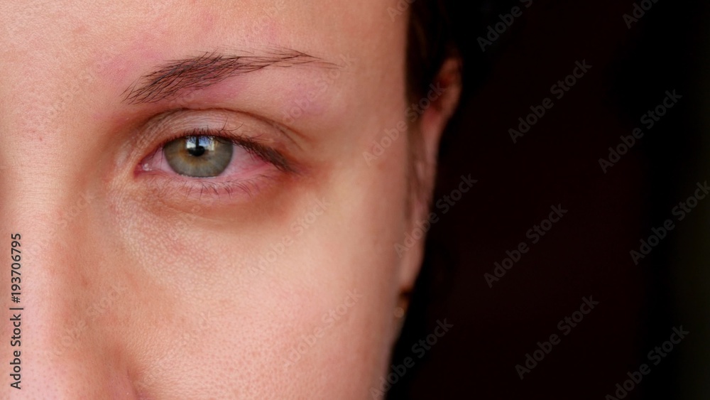 Sick red human eye of a young woman. A girl takes off her glasses