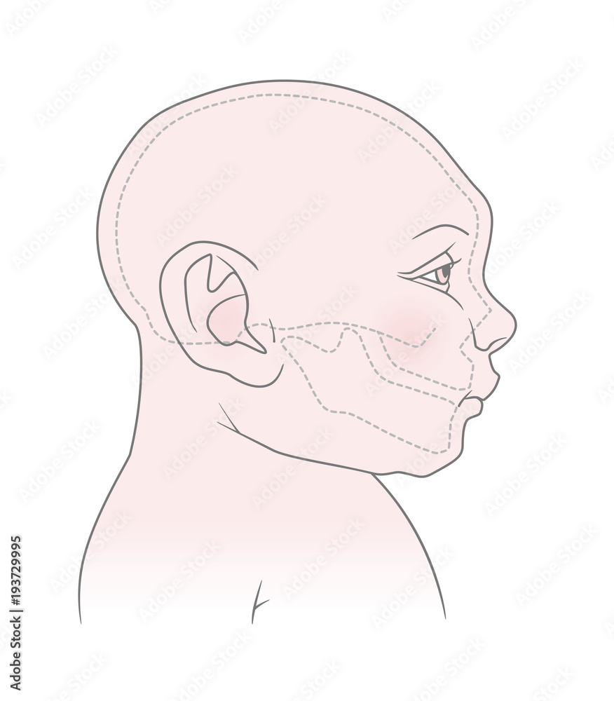 Anatomical image of the head and skull of a newborn child with microcephaly of the cranium. Virus Zika. Vector. Isolated on white background Anatomical image of the head and skull of a newborn child with microcephaly of the cranium. Virus Zika. Vector. Isolated on white background