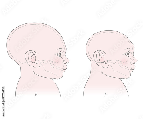 Comparative anatomical image of the head and skull of a newborn child with a normal cranium and with microcephaly. The virus of Zika. Vector. Isolated on white background