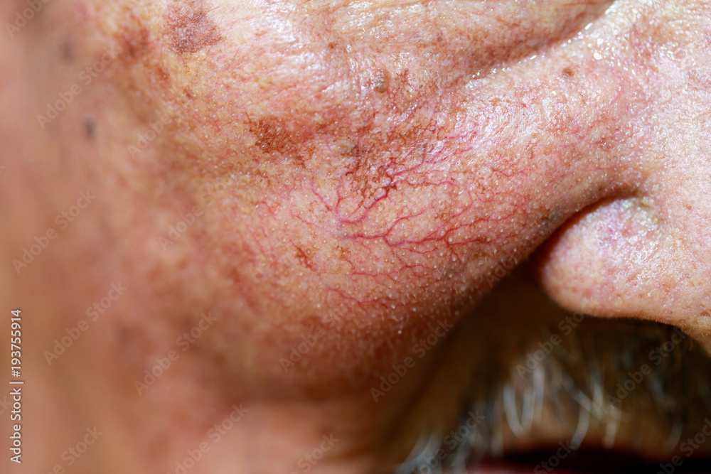 Fototapeta premium Capillaries on the face of the elderly man. Elderly Health Concept