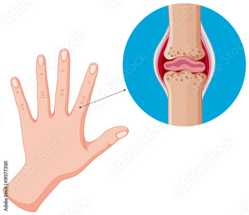 Human hand and bad joints, arthritis