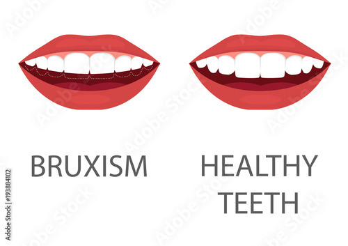 vector illustration of bruxism. grinding of teeth. tooth appliance. dental care. dentistry health problem