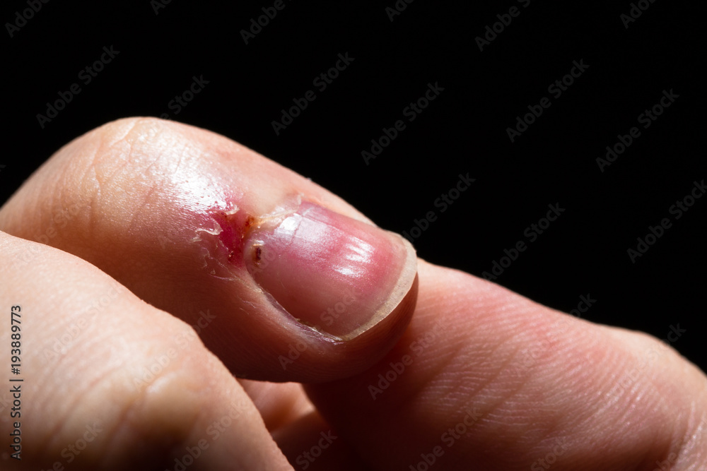 Right bruised bruise on a black background Right bruised bruise on a black background