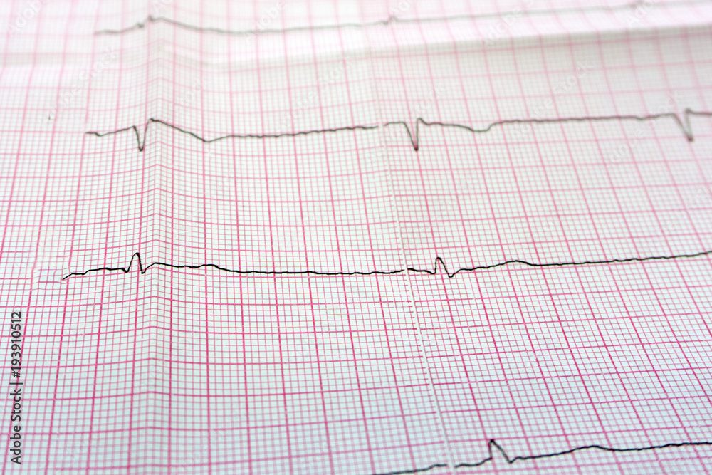 Close up of an electrocardiogram in paper form. Close up of an electrocardiogram in paper form.