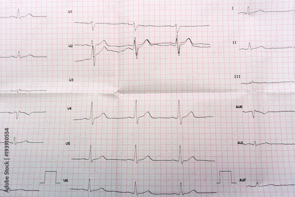 Emergency cardiology and intensive care. ECG with acute period of large-focal widespread anterior myocardial infarction .