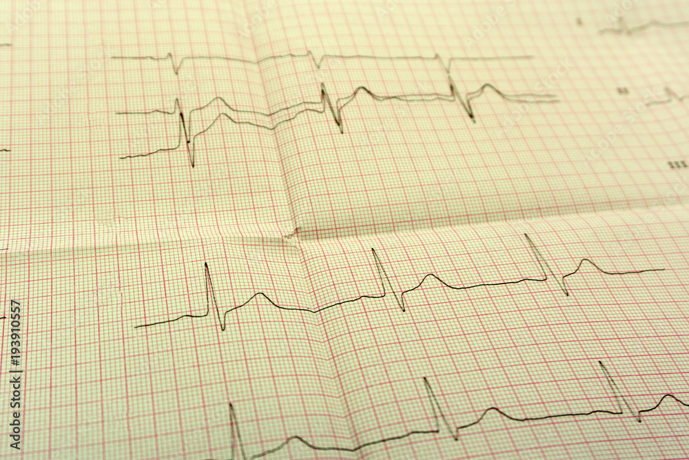 EGGor ECG paper the ECG Is the result of Stress test and pink heart shape out of pills. The promotion package to check your heart up high or older the concept of people.