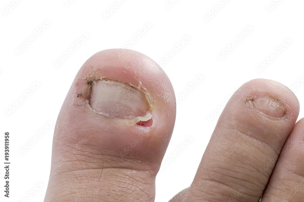 Close up figure out the nail, Accident nail trauma,bleeding toe nails.  Stock Photo | Adobe Stock