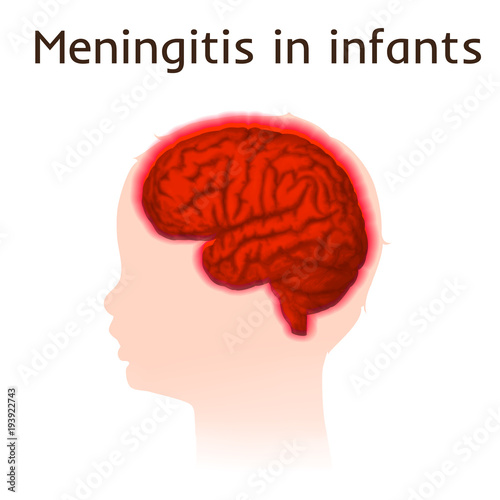 Meningitis in infants. Vector medical illustration. Kid, baby, childhood. White background, silhouette of child head, anatomy image of brain.
