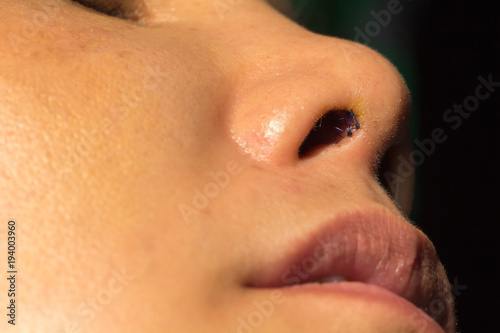 Close up woman nose with scar from plastic surgery.
