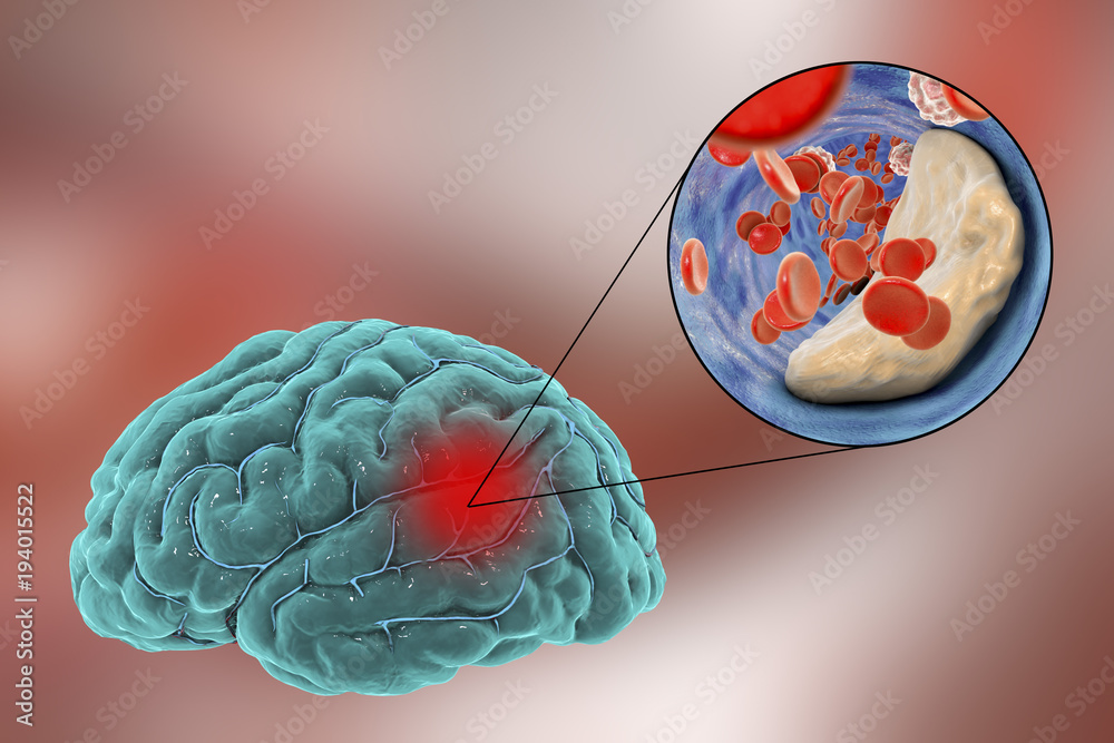 Ischemic brain stroke concept, 3D illustration showing human brain and closeup view of blood