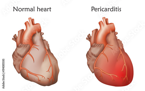 Pericarditis. Inflammation of the pericardium. Damaged and normal heart muscles. Anatomy illustration. Colorful image, white background. photo
